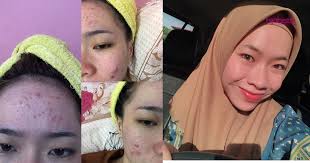 Jerawat merupakan salah satu masalah kulit yang paling menyebalkan dan mudah menjalar. Gadis Ini Share Cara Rawat Masalah Breakout Yang Dihadapinya Dalam Masa 5 Bulan Wajah Pulih Hijabista