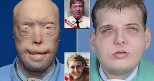 Face transplant : r/WTF