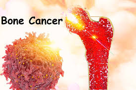 Bone Cancer: हड्डी का कैंसर कितना खतरनाक है? जानिए इस लेख में - हैलो स्वास्थ्य