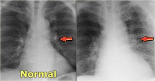 The Radiology Assistant Heart Failure This is a failure of the heart to pump blood efficiently enough to supply the body with the oxygen and nutrients it requires. the radiology assistant heart failure