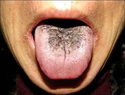 It entails having small or tiny black dots on different parts of this is a naturally occurring pigment that gives the skin, hair, or fur the dark color. Black Hairy Tongue Studio Dentaire