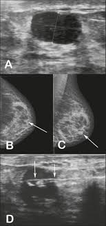 Finally, we look into some benign conditions that people may mistake for breast cancer. Scielo Brasil Tubular Adenoma Of The Breast Radiological And Ultrasound Findings Tubular Adenoma Of The Breast Radiological And Ultrasound Findings