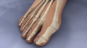4)metatarsal stress fracture most people don't think orthotics will fix their foot pain. Hallux Valgus Bunions Uw Orthopaedics And Sports Medicine Seattle