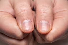 We did not find results for: Covid Nails Could Be A Sign Of Previous Infection The Key Symptoms To Look For Yorkshire Evening Post