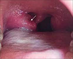 They are squamous cell carcinoma and lymphomas. Tuberculosis Of The Tonsil Simulating A Cancer The Lancet Infectious Diseases