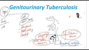 Image result for Genitourinary Tuberculosis