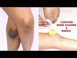 How do i remove dark knees? How To Lighten Dark Underarms In 2 Easy Steps Mask Amp Scrub To Lighten Dark Armpits Khichi Beauty Youtub Dark Elbows Dark Spots On Skin Dark Underarms