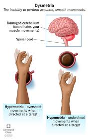 Image result for Cerebellar Function Test
