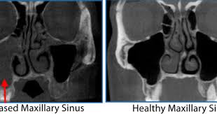 Those on high deductible health plans or without insurance can save when they buy their procedure upfront through mdsave. 3 D Sinus Imaging Ct Scan Of The Sinuses Ny Allergy Sinus Centers
