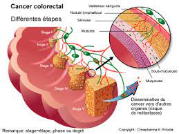 Cancer du poumon et des os.chance de survie?? Cancer Colorectal Causes Symptomes Traitements Creapharma