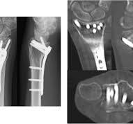 Volar Locking Plate Fixation for Distal Radius Fractures by ...