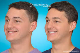 How to fix underbite at home. Milenium Home Tips 1 Year Old Underbite