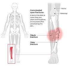 Woods' agent, mark steinberg, initially said his client suffered multiple leg injuries. Tiger Woods Injuries A Lifetime Of Damage In 45 Years