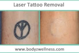 One client quick 8 stage before and after laser tattoo removal video via our clinic in hull, uk. Laser Tattoo Removal Bodyz Wellness