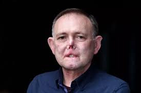 My dog scratched my hand