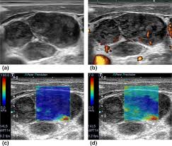 Ultrasound is often one of the first line tests in the detection of cancer. Differentiating Cervical Metastatic Lymphadenopathy And Lymphoma By Shear Wave Elastography Scientific Reports