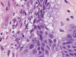 Herpes virus quickly settles in skin cells, where it multiplies extensively. Herpesvirales Sciencedirect