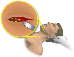 Lenf dokusunun habis tümörüne verilen genel bir isimdir. Lenfoma Nedir Prof Dr H Ismail Sari