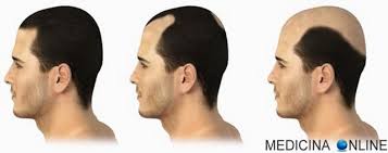 Secondo le statistiche circa il 20% dei giovani intorno ai 20 anni è soggetto ad una precoce (o precocissima) . Alopecia Qual E L Eta Di Insorgenza Nell Uomo E Nella Donna Medicina Online