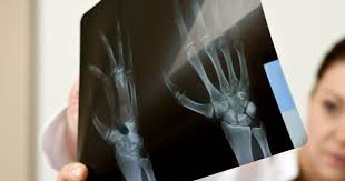 For more than half of women who develop stage iv breast cancer, the bones are the first site of metastasis. Bone Cancer The Arab Hospital Magazine