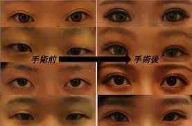 お得なモニター募集 no 002 3011 新宿本院 二重 二重整形 湘南美容外科 美容クリニック 募集 湘南