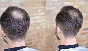 Please call or text for your appointment. Crown Hair Transplant Service à¤¹ à¤¯à¤° à¤Ÿ à¤° à¤¸à¤ª à¤² à¤Ÿ à¤¶à¤¨ à¤¬ à¤² à¤• à¤Ÿ à¤° à¤¸à¤ª à¤² à¤Ÿ à¤¶à¤¨ In Shaniwar Peth Pune Insta Hair Transplant Id 15417791373