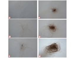 So, which needle length is best for hair loss? Hair Shedding Scale Scores Vary Between 1 Minimal Shedding To 6 Download Scientific Diagram