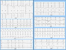 Examples Of Different Cardiac Arrhythmias With Correct A D