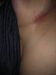 Image result for heat rash under breasts