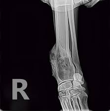 Image result for Osteosarcoma