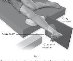 Image result for Ankle External Rotation Test