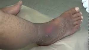 Gangrene is when part of your body tissue dies. Diabetes Gangrena Fisiopatologia Flujo Flujo De Entrevistas De Diabetes Tipo 2