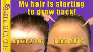 How can i get my hair to grow back? My Hair Is Growing Back Youtube