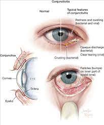 Conjunctivitis Pink Eye Treatment Pink Eyes Eye Treatment