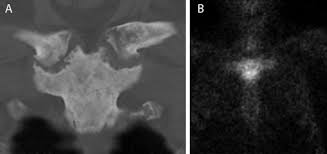 Image result for Osteomyelitis Bone Scan