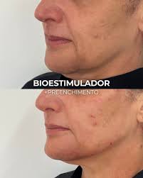 Rosto derretendo, também é sua queixa? Ela queria leveza, queria harmonia e  sem exageros. Queria se olhar no espelho e se enxergar novamente como era  há 10 anos atrás! ✨ 🫶Tratamos