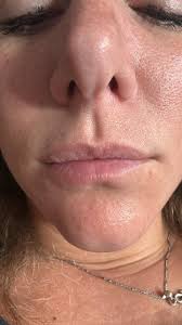 🚨 ‼️ 🔔 Last Call for Lip Filler Model Appointments! Thank you to everyone  who has already taken advantage of this fantastic opportunity to achieve  beautiful, rejuvenated lips at incredibly discounted prices.