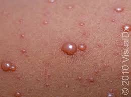 Image result for chickenpox