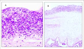Image result for Chorioamnionitis