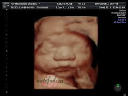 Tidak ada gunanya berjumpa doktor untuk melihat jantina bayi jika wanita itu baru saja kelewatan haids baru seminggu. Pregnant Kali Ini Klinik My Family Tetap Menjadi Pilihan Untuk Ultra Sound Baby Marshalizadotcom