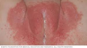 Image result for newborn diaper rash