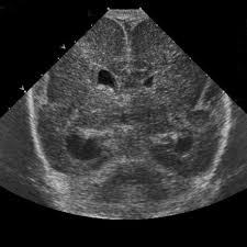 It is caused by defective neuronal migration during the 12th to. Lissencephaly Pachygyria Spectrum Radiology Reference Article Radiopaedia Org