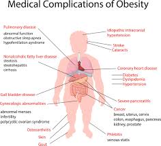 Image result for Obesity