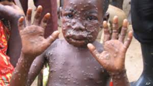 Monkeypox is caused by monkeypox virus, a member of the monkeypox is a viral zoonotic disease that occurs primarily in tropical rainforest areas of central and west. Monkeypox Strikes In Congo Voice Of America English