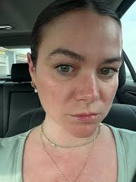 How to treat itchy and tender skin with a prosthetic liner?