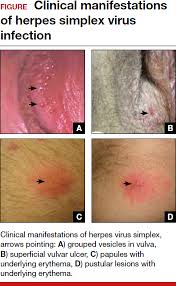 Image result for genital herpes