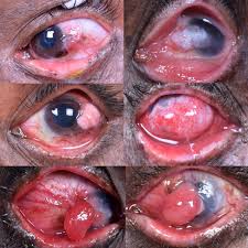 Xeroderma pigmentosum is a rare genetic disorder that affects the skin, the eyes, and sometimes the nervous system. Ocular And Periocular Tumors In Xeroderma Pigmentosum A Study Of 120 Asian Indian Patients American Journal Of Ophthalmology