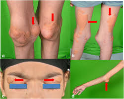 Image result for Hypercholesterolemia