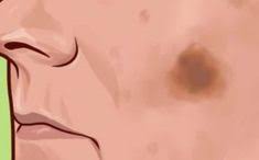 Yuzdeki Kahverengi Lekelerin Kesin Tedavisi Icin Bitkisel Dogal Maske Flecken Im Gesicht Hautbehandlung Gesicht