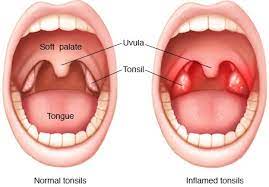 Bila sakit, bertambah besar dan merah. 9 Cara Efektif Merawat Tonsil Bengkak Pada Bayi Kanak Kanak